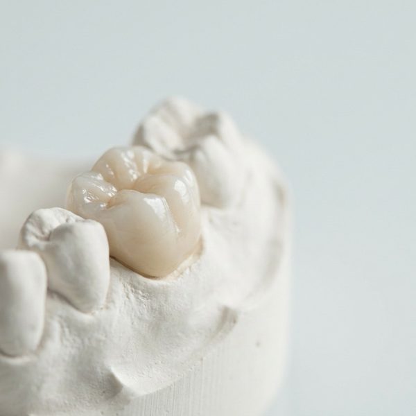 Corona de porcelana sobre un modelo dental